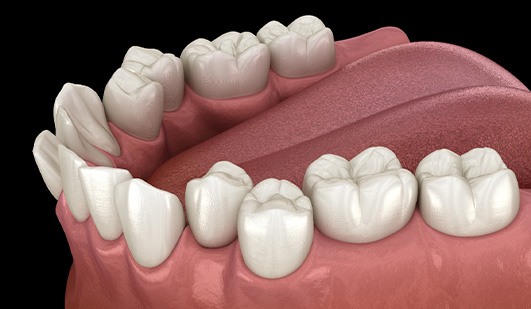 Illustration of crooked teeth