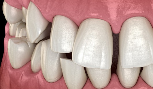 Illustration of gapped teeth