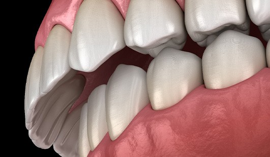 Illustration of an overbite