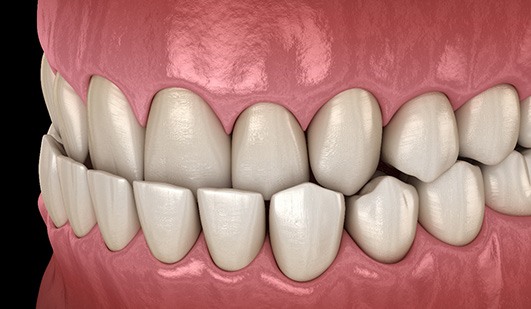 Illustration of an underbite