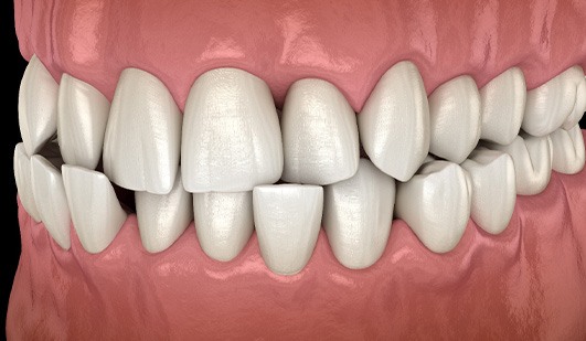 Illustration of a crossbite