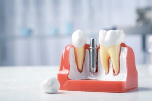 A dental implant seated in a mouth mold